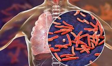 Aumentaron un 38% los casos de tuberculosis en Argentina